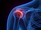 Radiografia en 3D del hombro