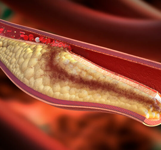 Imagen de una placa aterosclerótica inestable.