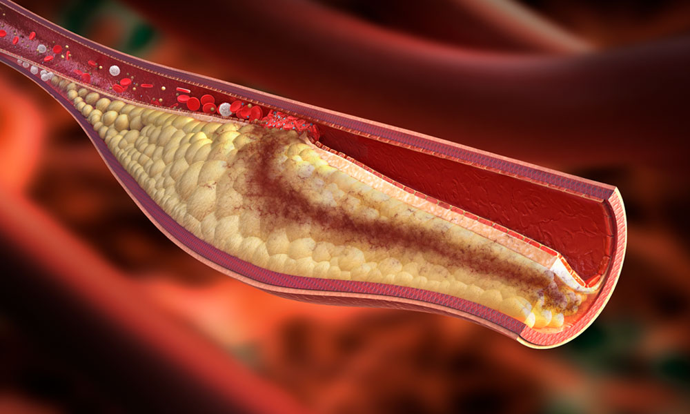 Imagen de una placa aterosclerótica inestable.