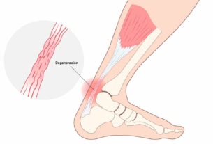 ilustración de pie con degeneración en el tendón de aquiles