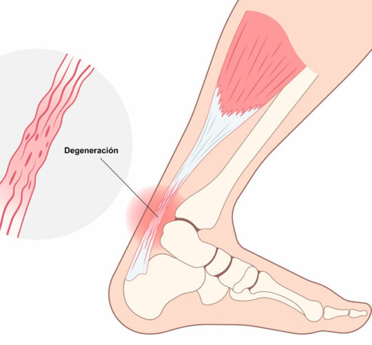 ilustración de pie con degeneración en el tendón de aquiles