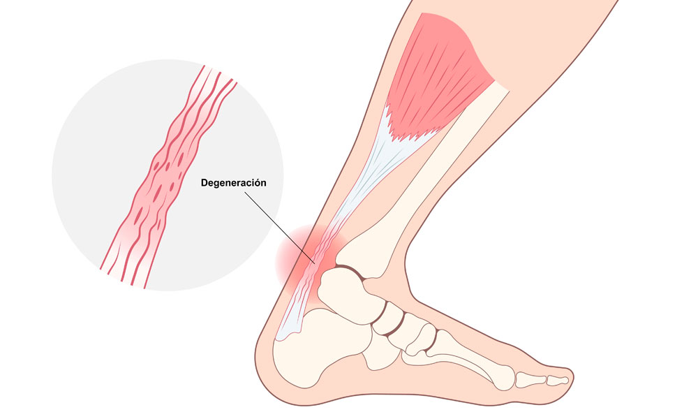 ilustración de pie con degeneración en el tendón de aquiles
