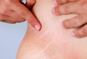 abdomen de mujer con estrias