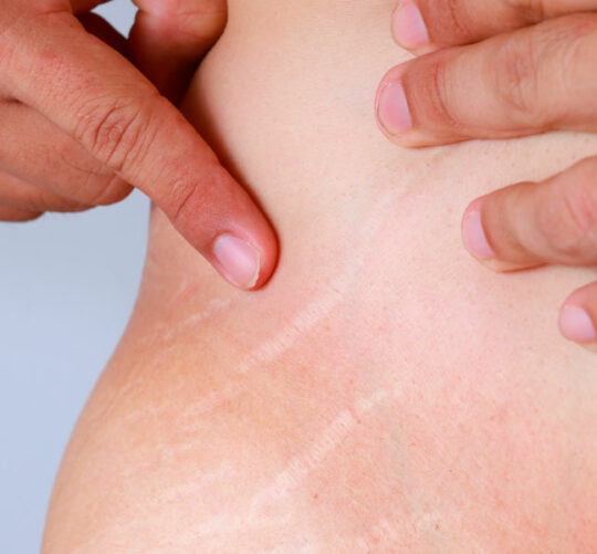 abdomen de mujer con estrias