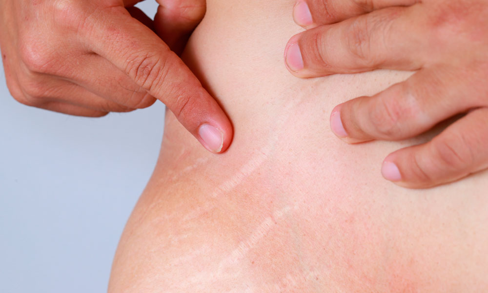 abdomen de mujer con estrias