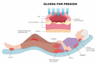 ilustración de mujer acostada señalando zonas de ulcera por presión
