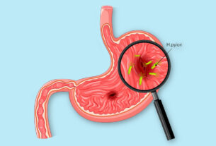 ilustración del estomago con bacteria helicobacter pylori
