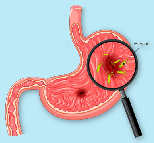ilustración del estomago con bacteria helicobacter pylori