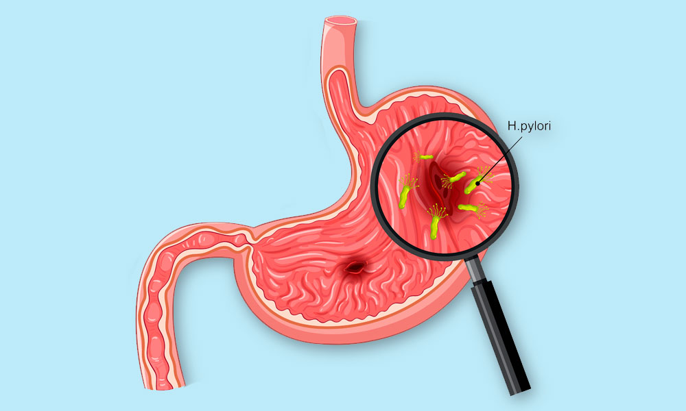ilustración del estomago con bacteria helicobacter pylori