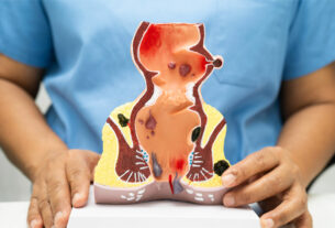 modelo de anatomía humana de recto con hemorroides