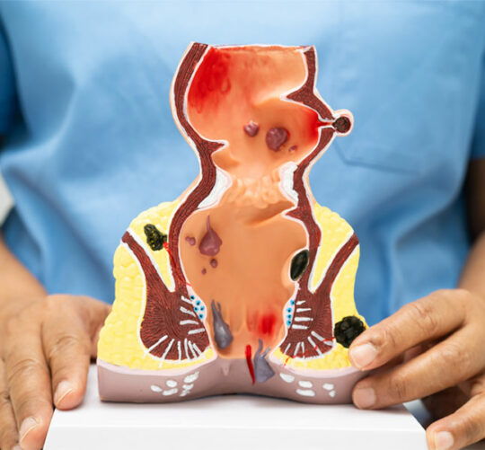 modelo de anatomía humana de recto con hemorroides