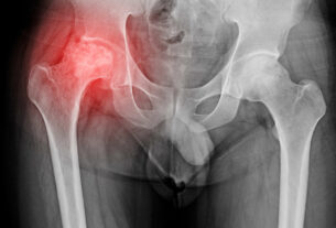 radiografia de osteoartritis de cadera