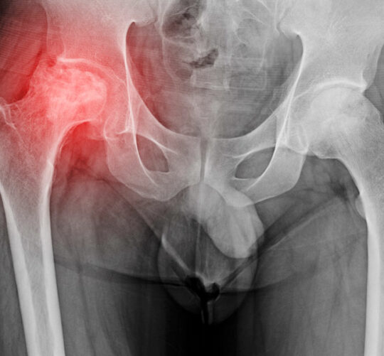 radiografia de osteoartritis de cadera