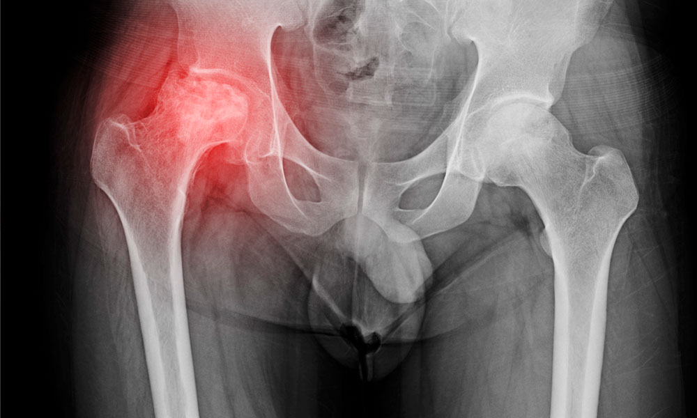 radiografia de osteoartritis de cadera