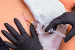 paciente recibiendo inyección de aceite de girasol ozonizado en herida