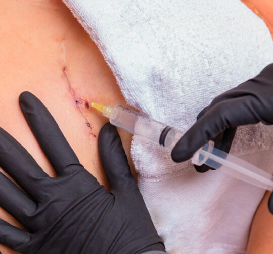 paciente recibiendo inyección de aceite de girasol ozonizado en herida