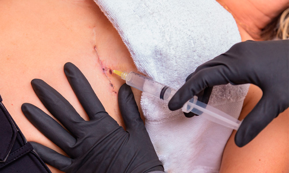 paciente recibiendo inyección de aceite de girasol ozonizado en herida