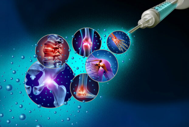 ilustracion en 3d Medicina Regenerativa del Dolor Articular
