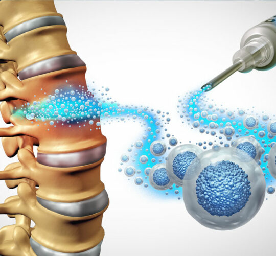 columna vertebral 3d nucleosis discal
