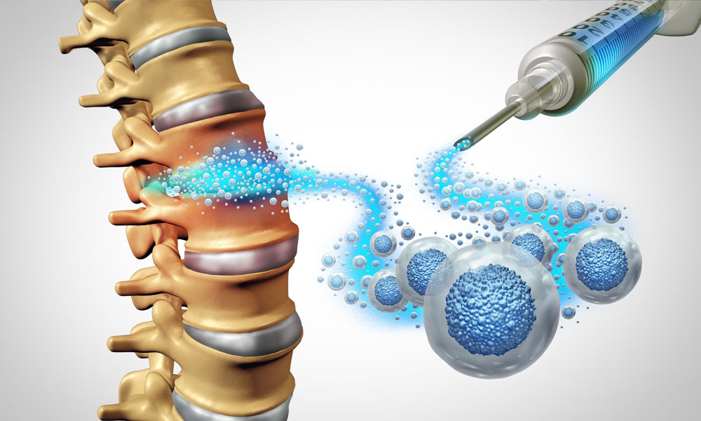 columna vertebral 3d nucleosis discal