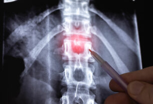 radiografia de columna vertebral con hernia discal