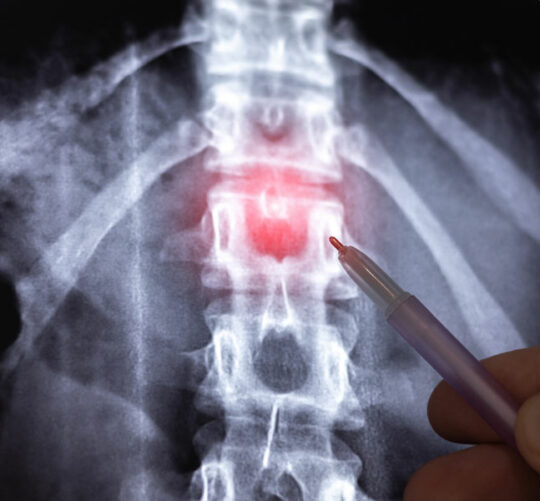 radiografia de columna vertebral con hernia discal