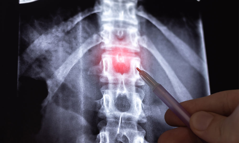 radiografia de columna vertebral con hernia discal