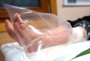 tratamiento de ozonoterapia con bolsa de campana