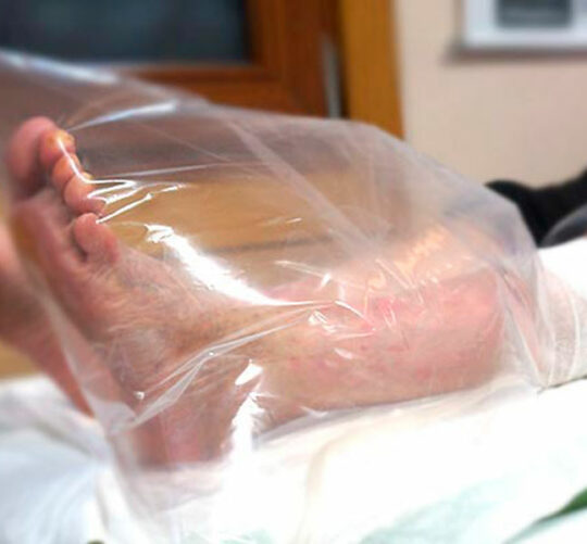 tratamiento de ozonoterapia con bolsa de campana