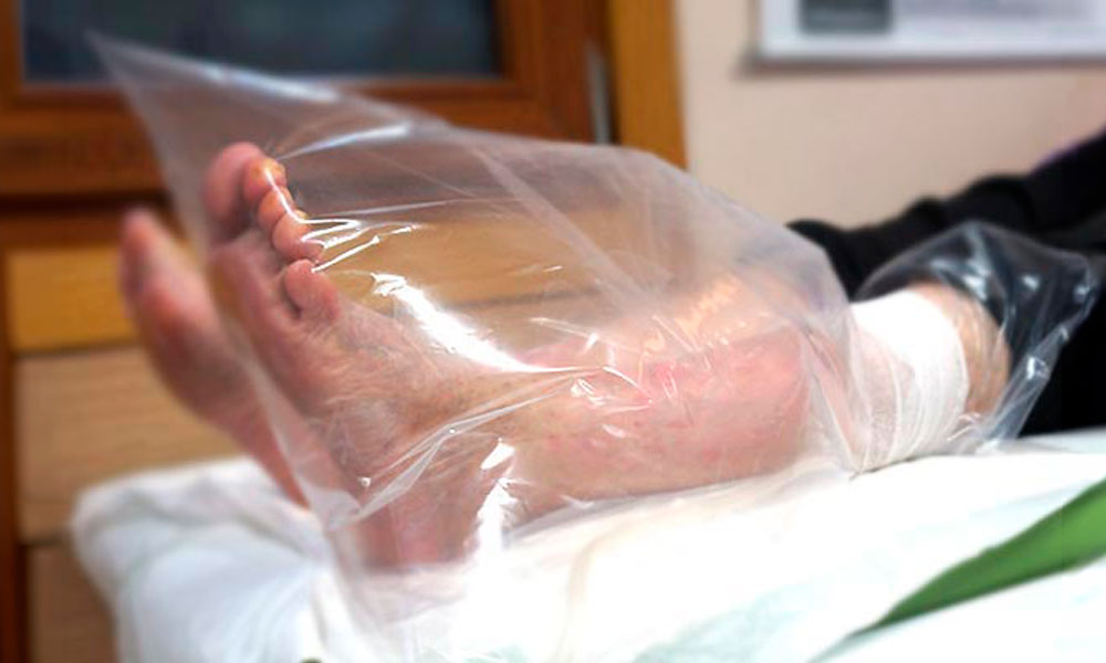 tratamiento de ozonoterapia con bolsa de campana