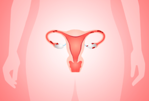 Ilustración de endometriosis en cuerpo femenino