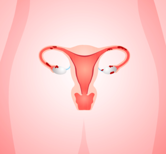 Ilustración de endometriosis en cuerpo femenino