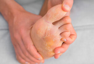 Pie de paciente con infección de pie de atleta