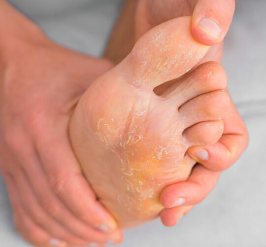 Pie de paciente con infección de pie de atleta