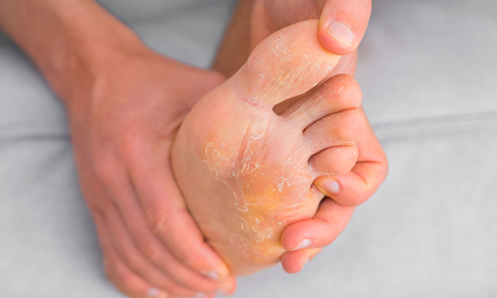 Pie de paciente con infección de pie de atleta