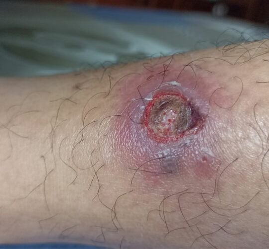 imagen de pierna con herida