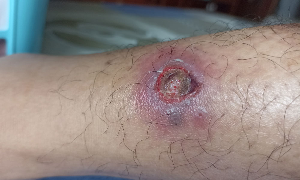 imagen de pierna con herida