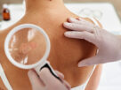 espalda de paciente con psoriasis revisada con lupa