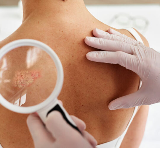 espalda de paciente con psoriasis revisada con lupa