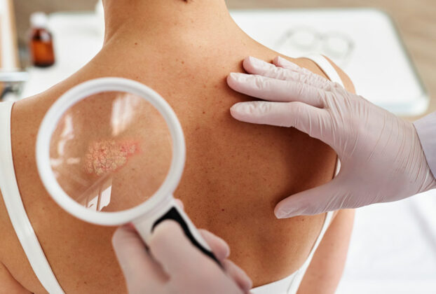 espalda de paciente con psoriasis revisada con lupa