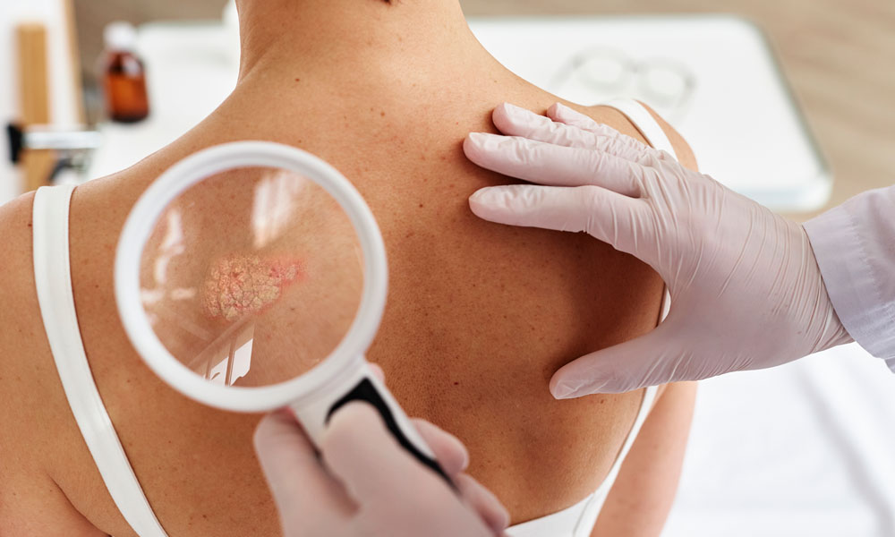 espalda de paciente con psoriasis revisada con lupa