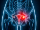 Inflamación de la parte pélvica, parte interior del cuerpo