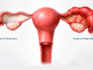 imagen 3d de trompas de falopio inflamada