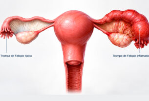 imagen 3d de trompas de falopio inflamada