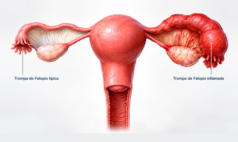 imagen 3d de trompas de falopio inflamada
