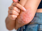 acercamiento a brazo de mujer con psoriasis