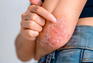 acercamiento a brazo de mujer con psoriasis