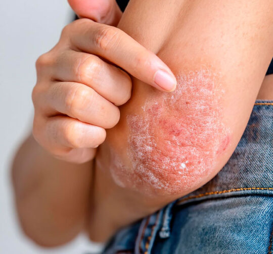 acercamiento a brazo de mujer con psoriasis