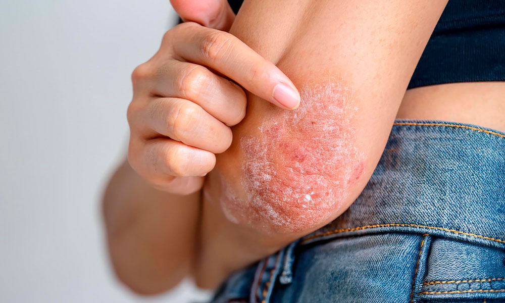 acercamiento a brazo de mujer con psoriasis